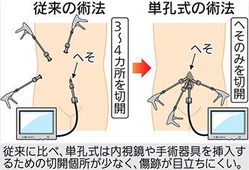 単孔式腹腔鏡下手術